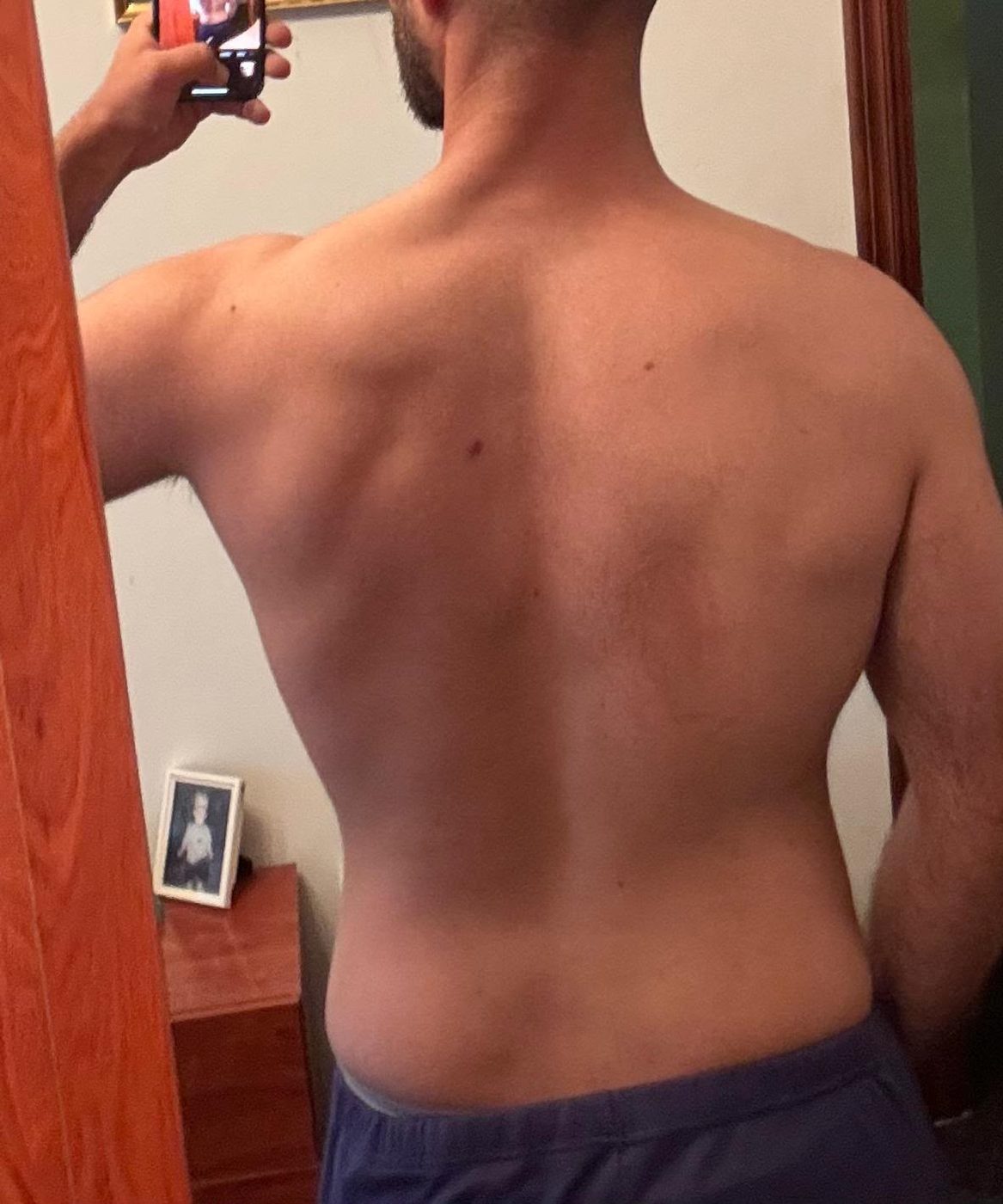 Tomás espalda antes